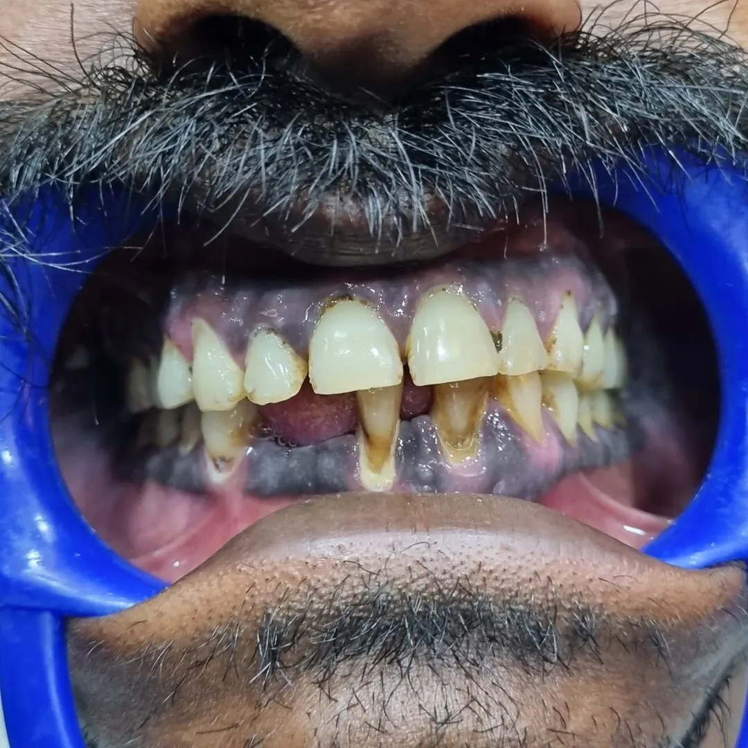 Smile Transformation 1