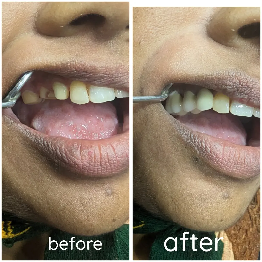 Smile Transformation 2