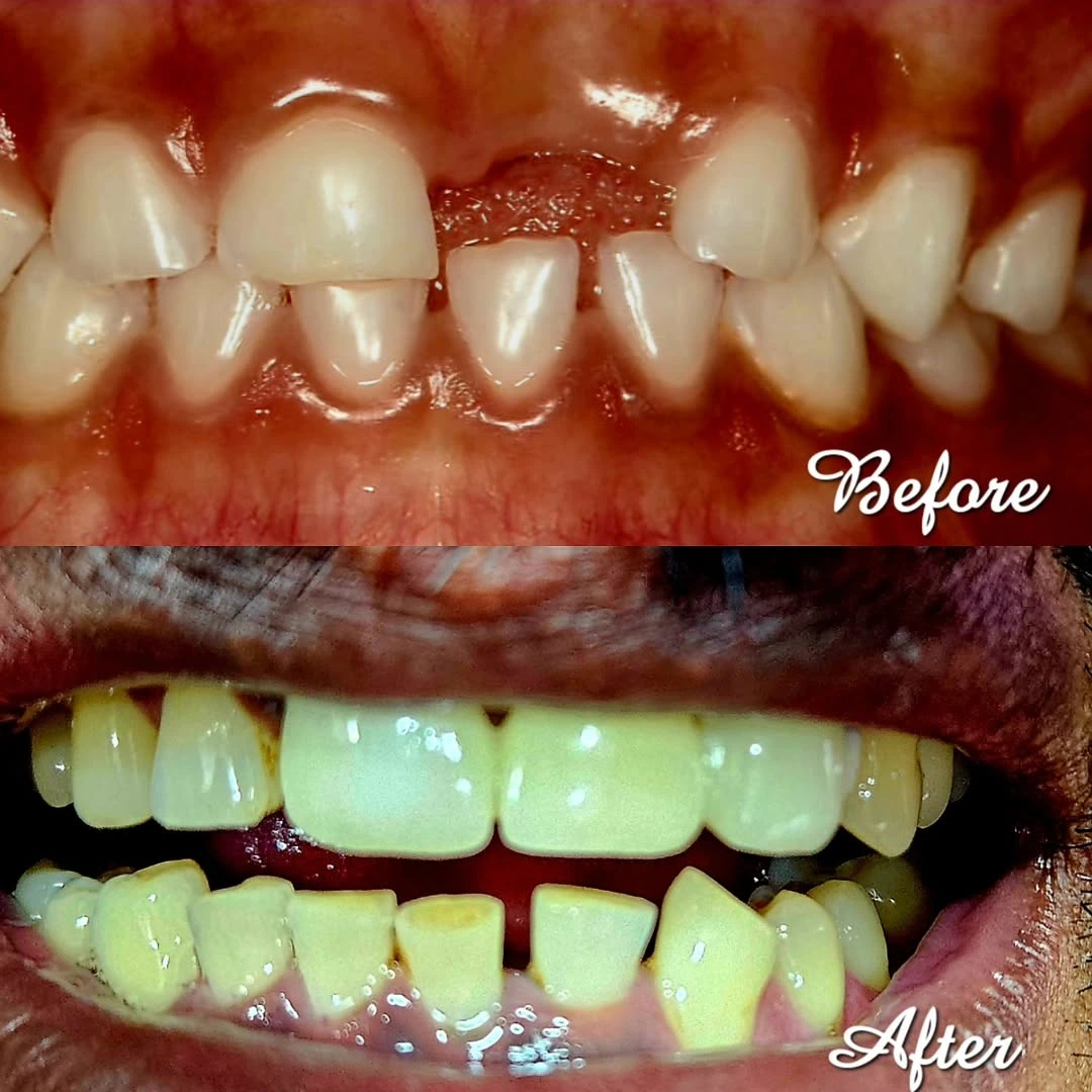 Smile Transformation 3