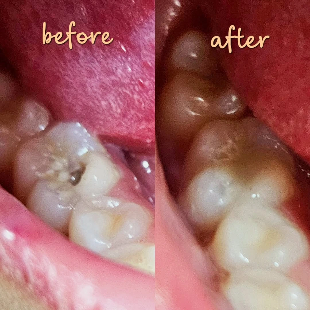 Smile Transformation 4