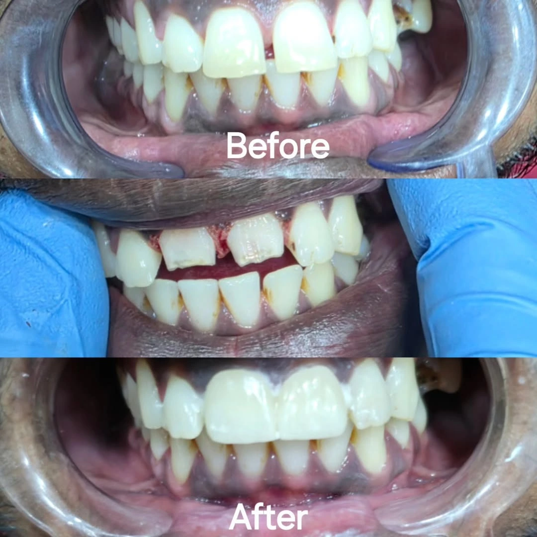 Smile Transformation 5