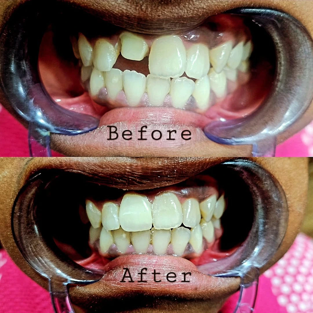 Smile Transformation 6
