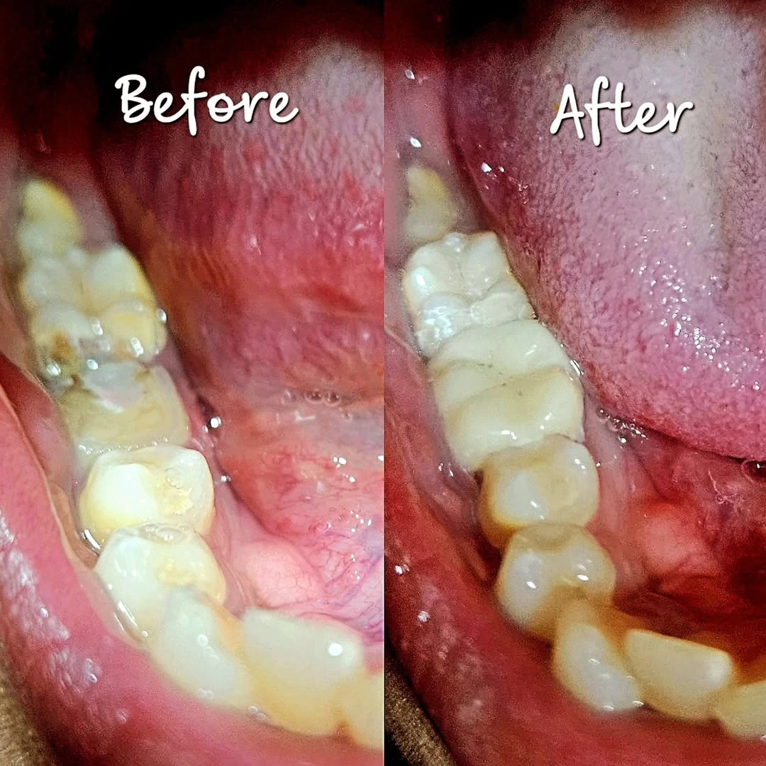 Smile Transformation 7