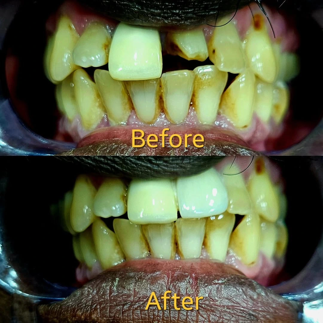 Smile Transformation 9