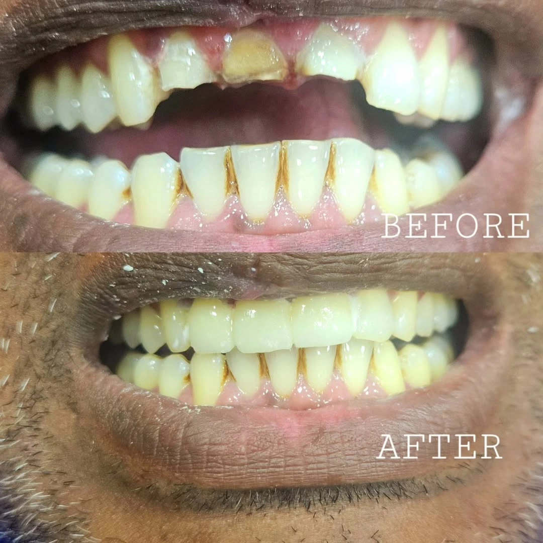 Smile Transformation 11